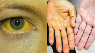 10 biểu hiện gan đang 'ngập' trong độc tố: Đi khám trước khi 'xơ như mướp'' hay bị K ác tính