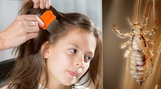 Con đi học bị lây chấy, mẹ làm theo cách này chấy khôn mấy cũng cao chạy xa bay