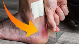 Thấy chân có xuất hiện 'điểm lạ' này thì nhanh đi khám ngay kẻo tắc mạch máu