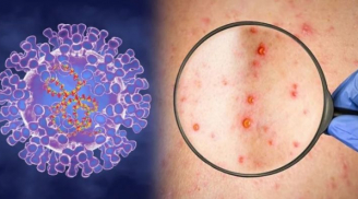 Virus đậu mùa khỉ bùng phát ở châu Âu: BS cảnh báo 3 đường lây và 7 triệu chứng bệnh