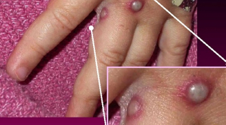 Nóng: Bộ Y tế khuyến cáo 6 biện pháp phòng chống bệnh đầu mùa khỉ