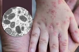 Đậu mùa khỉ là tình trạng khẩn cấp toàn cầu: Chuyên gia chỉ dấu hiệu nhận biết, cách phòng ngừa, ai cũng cần biết