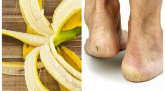 Vỏ chuối ăn xong đừng vội ném vào thùng rác: Sáng ra cứ lấy chà vào bàn chân sẽ thấy ngay điều kì diệu