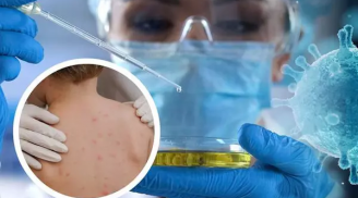 TP.HCM phát hiện 1 ca bệnh đậu mùa khỉ đầu tiên: Nếu có dấu hiệu này cần đi viện ngay lập tức