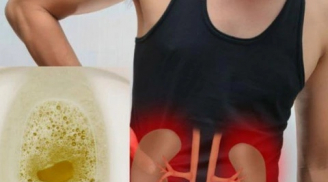 Nhìn nước tiểu buổi sáng biết ngay thận tốt hay không: Đi kiểm tra thận ngay nếu thấy màu đậm