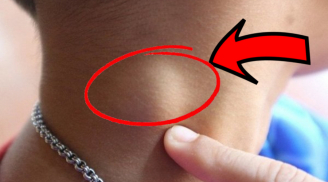 Người sắp bị K tấn công thường có 3 dấu hiệu lạ ở cổ, số 1 nguy hiểm nhất