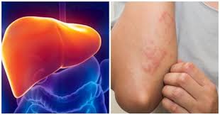 2 bộ phận đột nhiên bị ngứa đừng lầm tưởng là dị ứng, có thể là dấu hiệu của K gan, chớ chủ quan