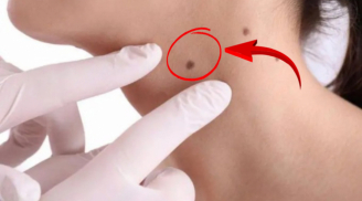 Ba vị trí mọc nốt ruồi cẩn thận bệnh K đang đến rất gần