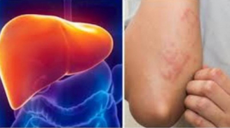 Ngứa 2 vị trí này báo hiệu gan đang kêu cứu, vị trí thứ nhất nhiều người làm tưởng bệnh ngoài da