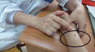 Người có 5 nốt ruồi 'đen' trên Sh88bet đăng ký miễn phí: Nam có tiền có quyền, nữ giàu 'ú ụ'