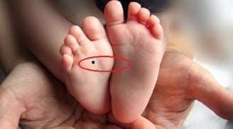 6 nốt ruồi là “thần may mắn”: Có 1 cái thôi thì cả đời không lo cơm ăn áo mặc, ngồi không cũng giàu