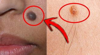 3 nốt ruồi 'cực phẩm' tượng trưng cho Tài Lộc Danh, 2 vị trí chặn đường của cải: Xem bạn có khônng?