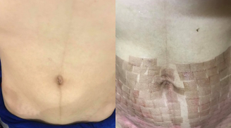 Bỏ ra 15 triệu đi làm đẹp sau sinh, mẹ trẻ phải chịu đau đớn vì bụng chi chít sẹo bỏng