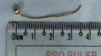 Phụ huynh cẩn trọng: Bé 7 tháng bị rách thực quản do nuốt hoa tai bằng vàng của mẹ