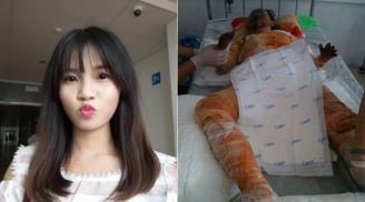 Đựng xăng vào túi ni lông: Cô gái xinh đẹp bị bỏng toàn thân, mặt biến dạng