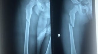 Thương tâm bé trai 10 tuổi bị cha dượng đánh đập tàn nhẫn