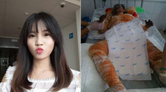 Cô gái xinh đẹp bị bỏng nặng do xăng đựng vào túi ni lông đã qua đời