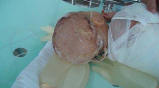 Ngã lộn vào nồi canh sôi 'khổng lồ' 25 lít, bé gái 21 tháng tuổi bỏng rất nặng