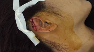Vụ cô giáo bị phụ huynh cắn đứt tai: Công an vào cuộc làm rõ nghi vấn