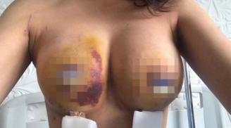 Nữ khách hàng 'tố' bệnh viện làm hỏng ngực: Đề nghị thành lập Hội đồng chuyên môn