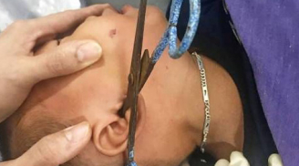 Cha mẹ lơ là, bé trai 2 tuổi bị kéo đâm sâu vào tai
