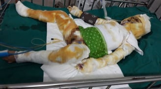 Vụ cháu bé bị bỏng toàn thân khi xem nướng mực: Xót xa trước gia cảnh vô cùng khó khăn của cháu bé