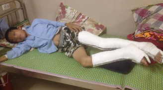 Bị cô giáo thu điện thoại, nam sinh lớp 9 nhảy từ tầng 3 xuống đất, bị gãy và vỡ xương cả hai chân