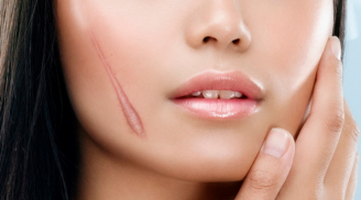 Da trắng không tỳ vết, sẹo lồi lõm được 'là phẳng' hoàn toàn chỉ với cách làm cực rẻ tiền này!