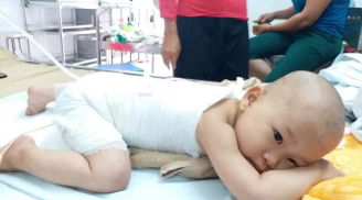 Làm mát vết bỏng cho con 16 tháng tuổi bằng kem đánh răng, mẹ nào ngờ con nguy kịch nhập viện