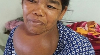 35 năm trời 'đeo' bướu nặng gần 3kg trên cổ, người phụ nữ hạnh phúc vì đã được 'giải thoát'