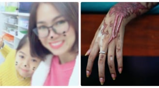 Ghen tuông, chồng cũ tưới axit khắp người vợ trước mặt con gái