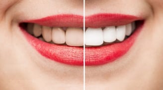 Bật mí 'bí kíp' khiến răng luôn trắng sáng, đánh bay nỗi lo vàng ố hay xỉn màu