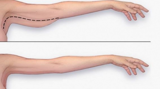 Mách nhỏ bạn tuyệt chiêu để cánh tay bướm không còn khiến bạn phải e ngại khi mặc áo sát nách