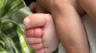 Chỉ vì sợi tóc rụng của mẹ, bé trai 10 tuần tuổi suýt cắt bỏ 4 ngón - lời cảnh báo tới cha mẹ
