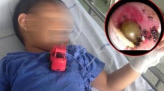 Ve chó làm tổ lúc nhúc trong tai bé trai, mẹ hoảng hồn khi biết nguyên nhân thực sự