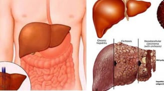 Vạch mặt thực phẩm quen thuộc khiến lá gan nhàu nát, đối mặt với ung thư quá nhiều người chuộng