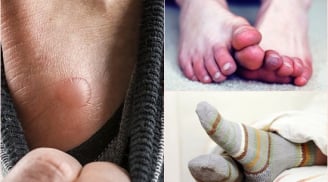 Bác sĩ khuyến cáo nhất thiết phải giữ ấm bàn chân trong mùa đông kẻo hối không kịp