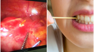 Cô gái 30 tuổi thủng ruột do thói quen mà hàng triệu người Việt vẫn hay làm sau khi ăn