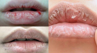 Thủ phạm khiến môi khô, nứt nẻ, bong tróc quanh năm suốt tháng