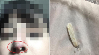 Đi nâng mũi bọc sụn, về nhà cô gái mới ngã ngửa vì thứ đưa vào mũi lại là 'thịt lừa'