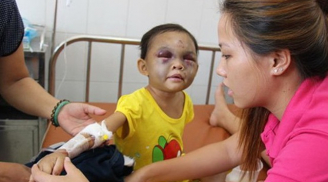 Cậu bé 6 tuổi xuất huyết não sau khi bị mẹ… tát: Cáu giận tới mấy cũng không đánh con ở vị trí này!