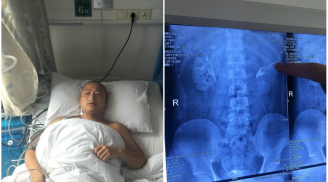 Nam thanh niên uống rượu thay nước lọc, đi khám phát hiện có 4 quả thận và lời cảnh báo của bác sĩ