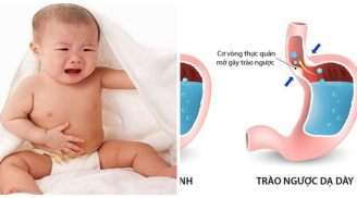 Con thường xuyên nôn trớ, mẹ dùng TUYỆT CHIÊU tránh cho con khỏi nhiều biến chứng nguy hiểm