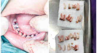Lặp đi lặp lại thói quen tai hại này khiến bé 4 tuổi mất 18 chiếc răng, đọc để không làm hại con yêu