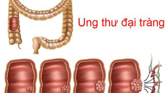 Uống 1 lon nước ngọt/ngày: Ung thư xuất hiện sớm, tăng nguy cơ t.ử v.ong