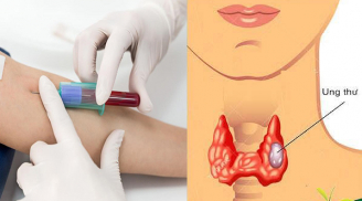 Nếu không muốn mắc ung thư, phụ nữ từ 20-40 tuổi nhất định phải làm 6 xét nghiệm cực quan trọng này
