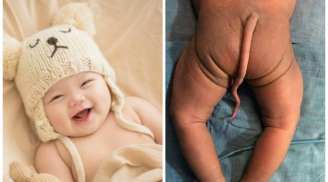 Bé sinh ra với cái đuôi 16cm khiến ai cũng 'sốc': BS cảnh báo dị tật thai nhi, mẹ bầu đừng vội bỏ qua
