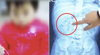 Bé 9 tháng tuổi 'mọc' đầy sỏi ở thận, bà mẹ bật khóc khi biết nguyên nhân chính từ thứ này