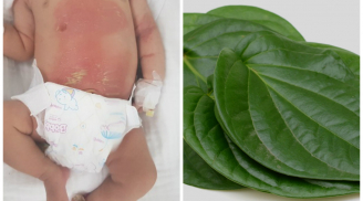 Chữa chướng bụng cho con theo cách dân gian, bé 14 ngày tuổi bị bỏng nặng nguy hiểm tính mạng