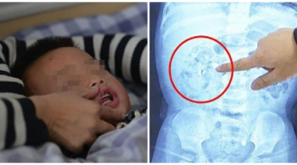 Bé gái 9 tháng tuổi thận chứa đầy sỏi vì mẹ tự ý bổ sung gấp đôi lượng canxi cho con